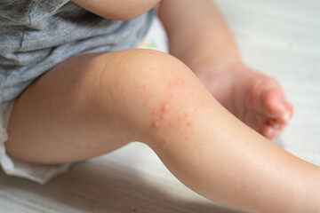 手足口病に罹患した一歳の男の子