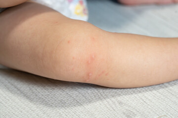 手足口病に罹患した一歳の男の子