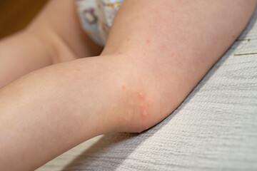 手足口病に罹患した一歳の男の子