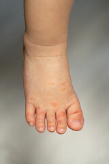 手足口病にかかった一歳の男の子