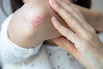 Close-up of a person touching a red, dry patch of skin on their elbow, showing signs of psoriasis or eczema, highlighting a skin condition that requires treatment or care.
