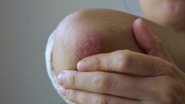 Close-up of a person touching a red, dry patch of skin on their elbow, showing signs of psoriasis or eczema, highlighting a skin condition that requires treatment or care.