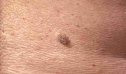 Nevus close-up. Mole on human skin. Irregular birthmark.