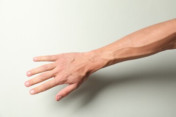 Man with bulging veins on his arm against light background, closeup