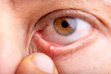 Ophthalmic hordeolum, close-up of an adult male eye with a stye (ophthalmic hordeolum), selective...