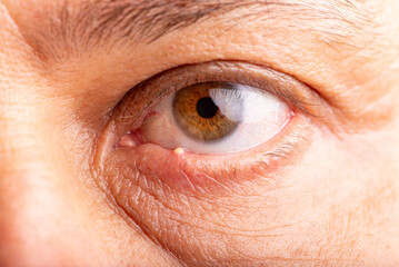 Ophthalmic hordeolum, close-up of an adult male eye with a stye (ophthalmic hordeolum), selective focus.