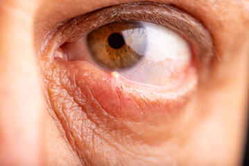 Fototapeta premium Ophthalmic hordeolum, close-up of an adult male eye with a stye (ophthalmic hordeolum), selective focus.
