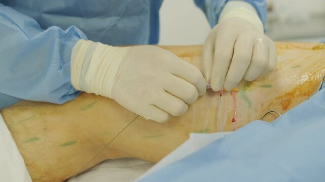 Leg Ulcer Wound in Treatment for Varicose Veins in Phlebology Procedure. Bonding of veins using bioglue