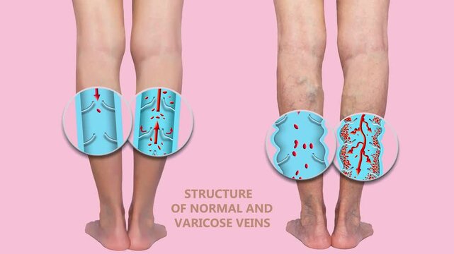 Varicose veins on a female senior legs. The structure of normal and varicose veins. Concept of dry skin, old senior people, varicose veins and deep vein thrombosis or DVT - 2D animation