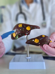 Surgeon hand holds scalpel with an anatomical figure of human liver.