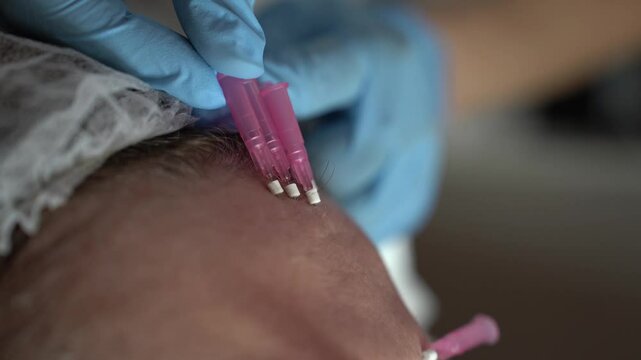 Video with woman having antiaging treatment with mesonites. Face Lifting.