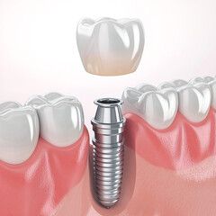 Illustration of a dental implant, a method of restoring a missing tooth, the implant is installed in the gums of the oral cavity, a dental plate prosthesis, new technologies.