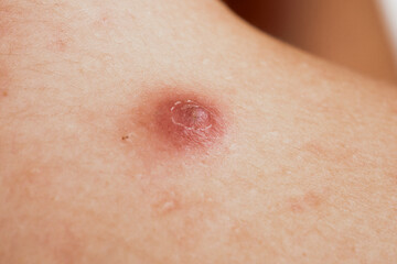 Pimple closeup. Skin background. Closeup acne pimple. Treatment for skin. Problem skincare....