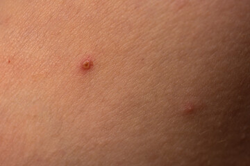 Fototapeta premium Skin background. Closeup acne pimple. Treatment for skin. Problem skincare. Pimples, acne, pores. Natural skin. Skin care concept. Acne treatment. Pimples on face. Acne and pimple.