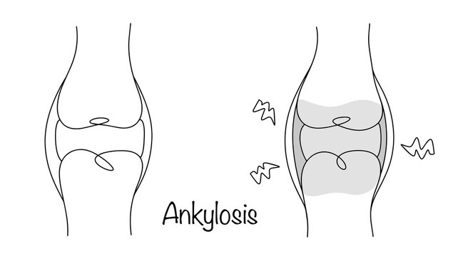 Ankylosis