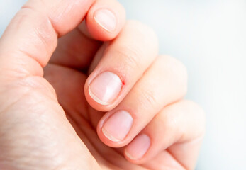 Close-up of cut (wounded) cuticle skin on a woman's middle finger. Manicure with a cut on the finger.