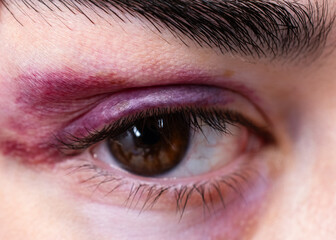 Close-up of a woman with a black eye 