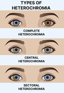 Heterochromia. Types of Heterochromia. Healthcare illustration. Vector illustration.