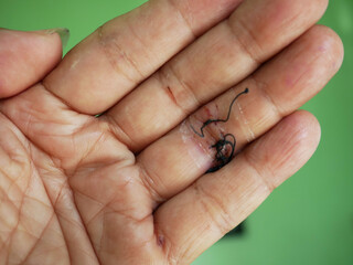 the injured finger is stitched, the wound on the ring finger is almost dry, the thread is on the...