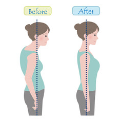 巻き肩、カバ肩などの悪い姿勢（猫背）の女性と、正しい姿勢の女性のビフォーアフター（重心線あり）