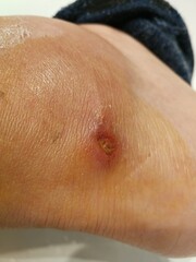 stingray sting on the ankle at Uvita Beach, Costa Rica