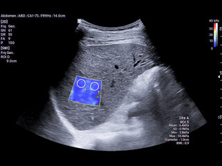 Ultrasound scan of the upper abdomen showing signs of chronic liver parenchymal disease. Ideal for...