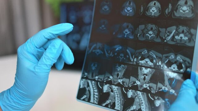 MRI image of the thyroid gland.