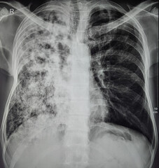 Chest xray showing miliary Tuberculosis. Differential diagnosis can be Metastatic Lung Carcinoma or...