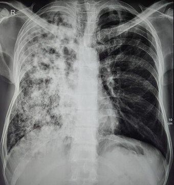 Chest xray showing miliary Tuberculosis. Differential diagnosis can be Metastatic Lung Carcinoma or Post TB fibrosis 