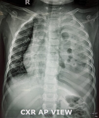 Chest Xray of Congenital Diaphragmatic Hernia 