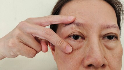 portrait showing the fingers holding the flabbiness adipose sagging skin, swelling and ptosis beside the eyelid, Flabby skin and creases on the face of the woman, health care and beauty concept.
