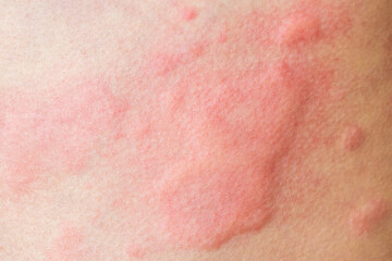 Fototapeta premium Skin allergy rash dermatitis texture close up background