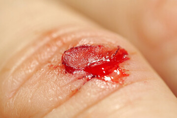 Injury of middle finger of right hand with bleeding. Flayed skin,blood and lymph