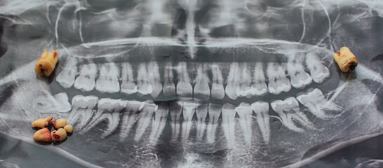 Wisdom teeth, 8th tooth with caries. Concept of dentistry and healthy teeth and oral cavity