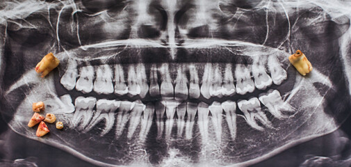Wisdom teeth, 8th tooth with caries. Concept of dentistry and healthy teeth and oral cavity