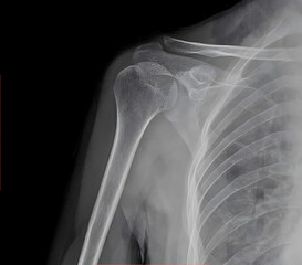 X-ray image of healthy shoulder joint showing clavicle and humerus, anterior view medical scan