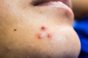 Close up of female face with red problematic acne skin and scars.