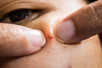 Woman touching pimple on face. Facial skin issues, medical care, and treatment concept.