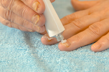 Treatment of nails affected by onycholysis with a healing ointment. Close-up