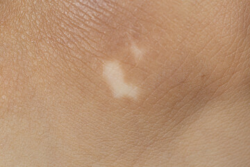 Fototapeta premium The image showcases a foot affected by vitiligo, with contrasting light and dark skin tones. Ideal for awareness and dermatological studies