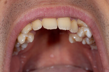 Obraz premium Open mouth view displaying misaligned teeth, focusing on jaw irregularities and the importance of proper dental alignment.