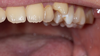 Fototapeta premium Close-up of a jaw exhibiting dental irregularities in an open mouth, highlighting the need for orthodontic evaluation