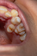 Obraz premium Close-Up of Misaligned Teeth