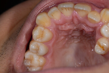 Dental Defects and Misalignment
