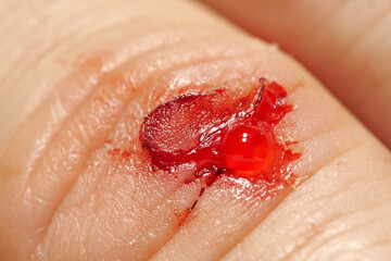 Injury of middle finger of right hand with bleeding. Flayed skin,blood and lymph