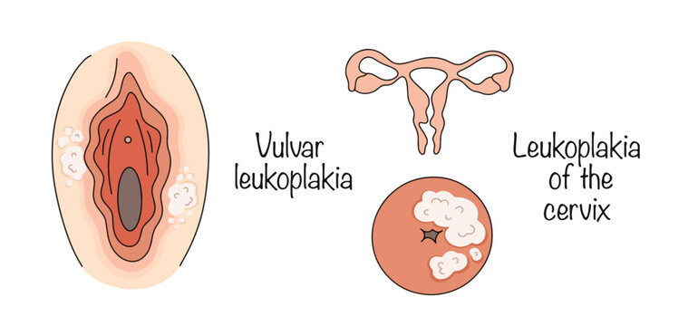 Vulvar leukoplakia. Leukoplakia of the cervix
