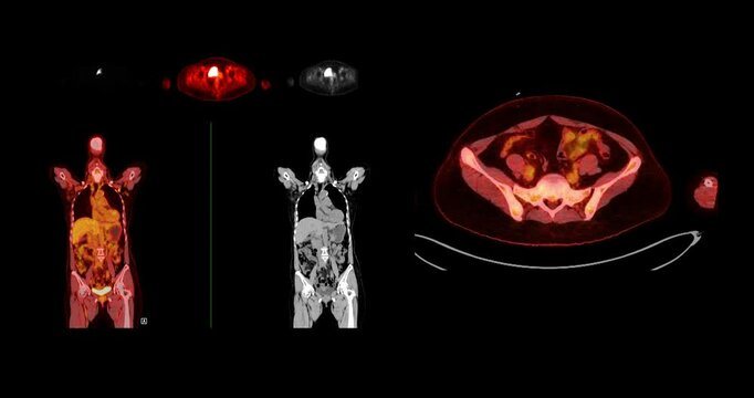 A PET-CT scan is a diagnostic imaging technique combining positron emission tomography (PET) and computed tomography (CT) in cancer diagnosis and staging. 