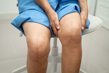 Asian elderly woman patient show her scars surgical total knee joint replacement Suture wound surgery arthroplasty on bed in hospital.