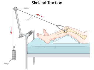 skeletal traction using weights and pulleys to align a leg fracture, showing the mechanism components and setup hand drawn schematic raster illustration. Medical science educational illustration