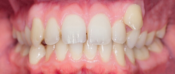 Close-up of crooked teeth needing orthodontic treatment and alignment
